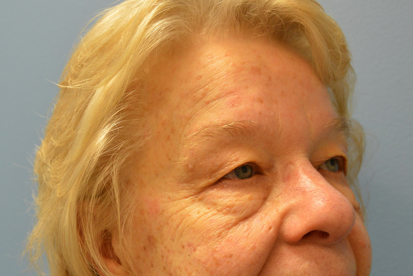 before blepharoplasty diagonal view female patient case 3798