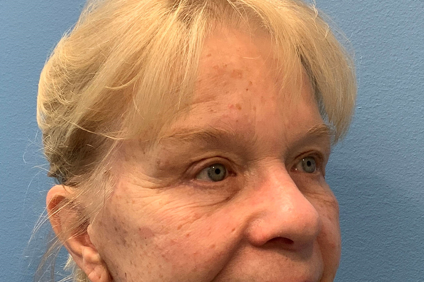 after blepharoplasty diagonal view female patient case 3798