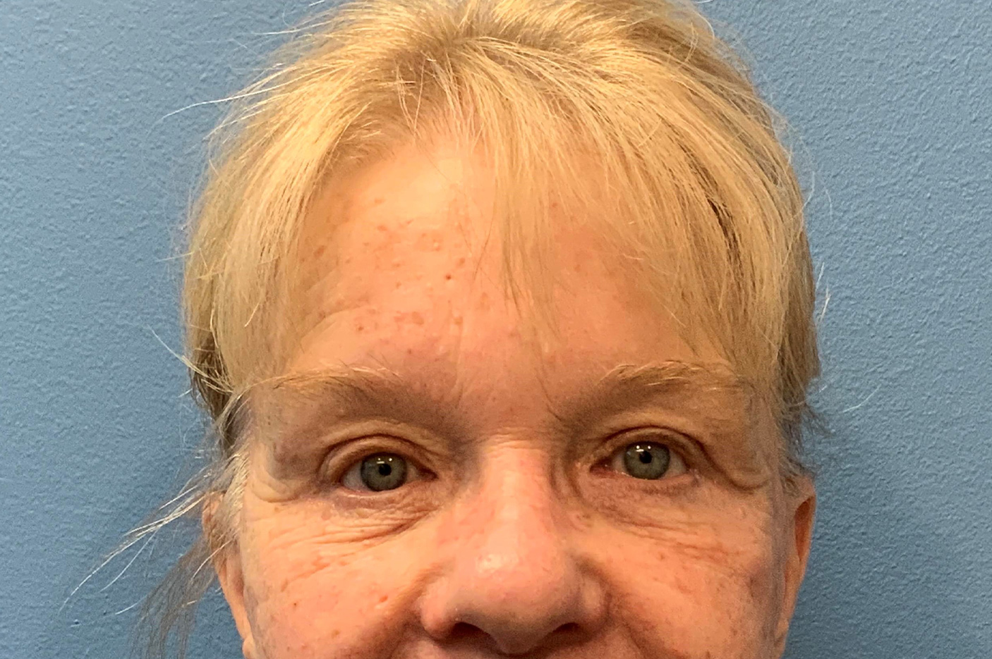 after blepharoplasty front view female patient case 3798