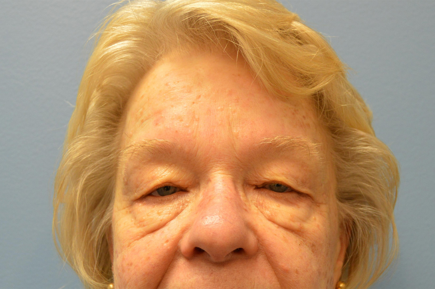 before blepharoplasty front view female patient case 3798