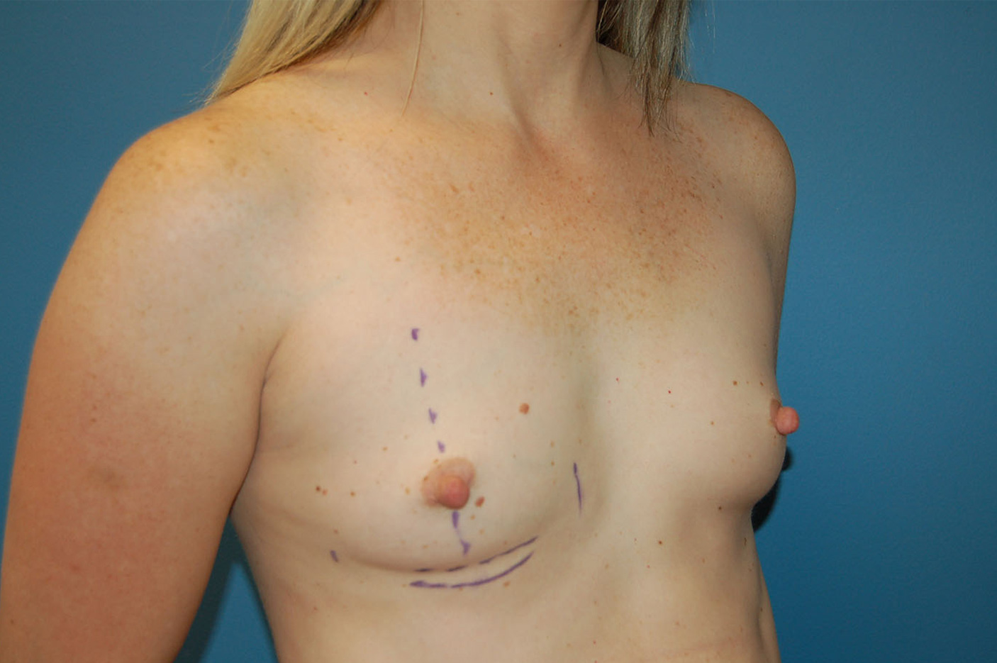 before breast augmentation right angle view Richmond, VA Zinsser Plastic Surgery