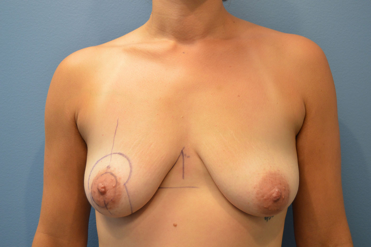 before breast augmentation front view Richmond, VA Zinsser Plastic Surgery