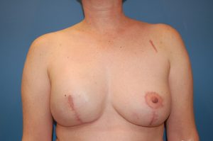 after breast reconstruction front view Richmond, VA Zinsser Plastic Surgery