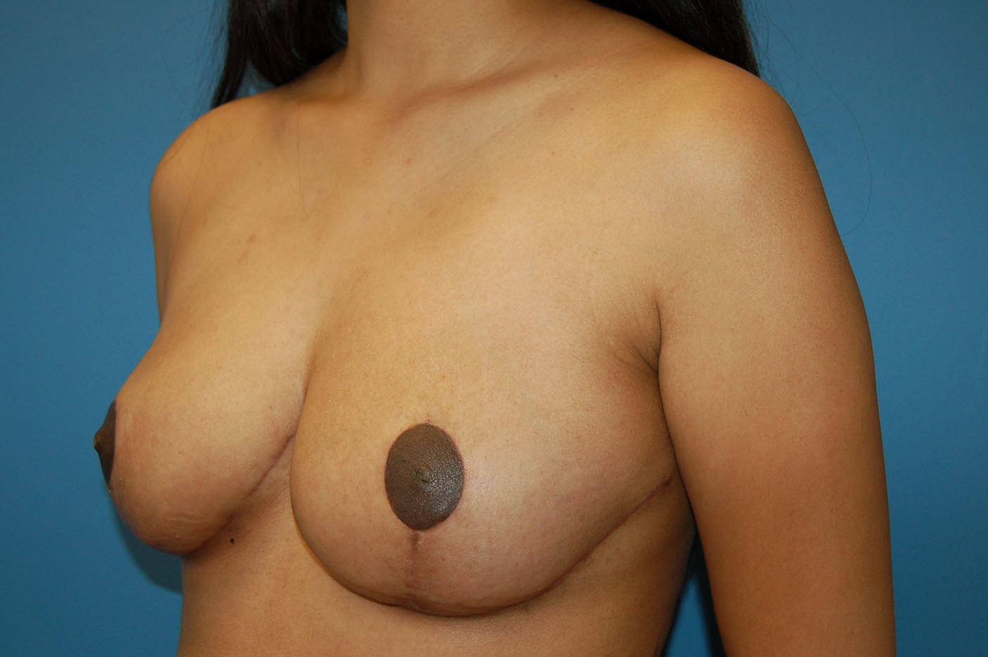 after breast reduction left angle view Richmond, VA Zinsser Plastic Surgery