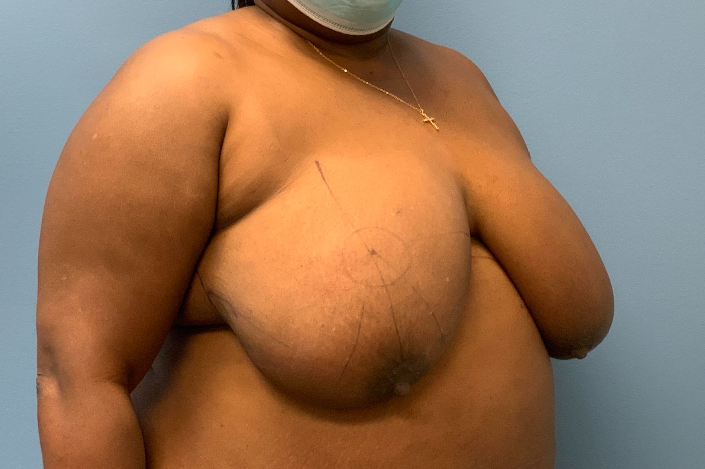 Before breast reduction right angle view female patient case 3996