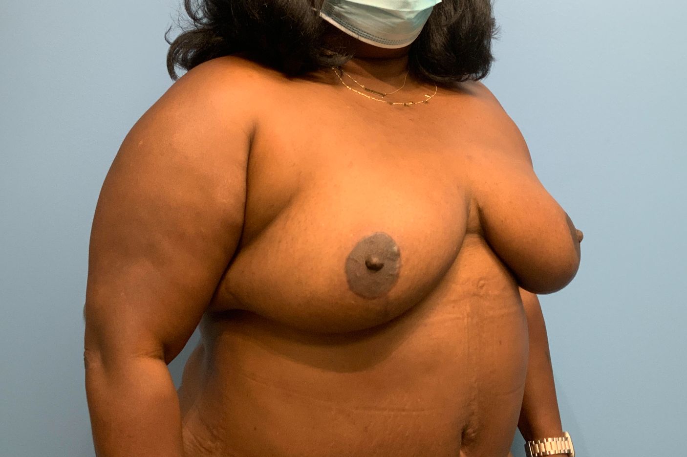 after breast reduction right angle view female patient case 3996