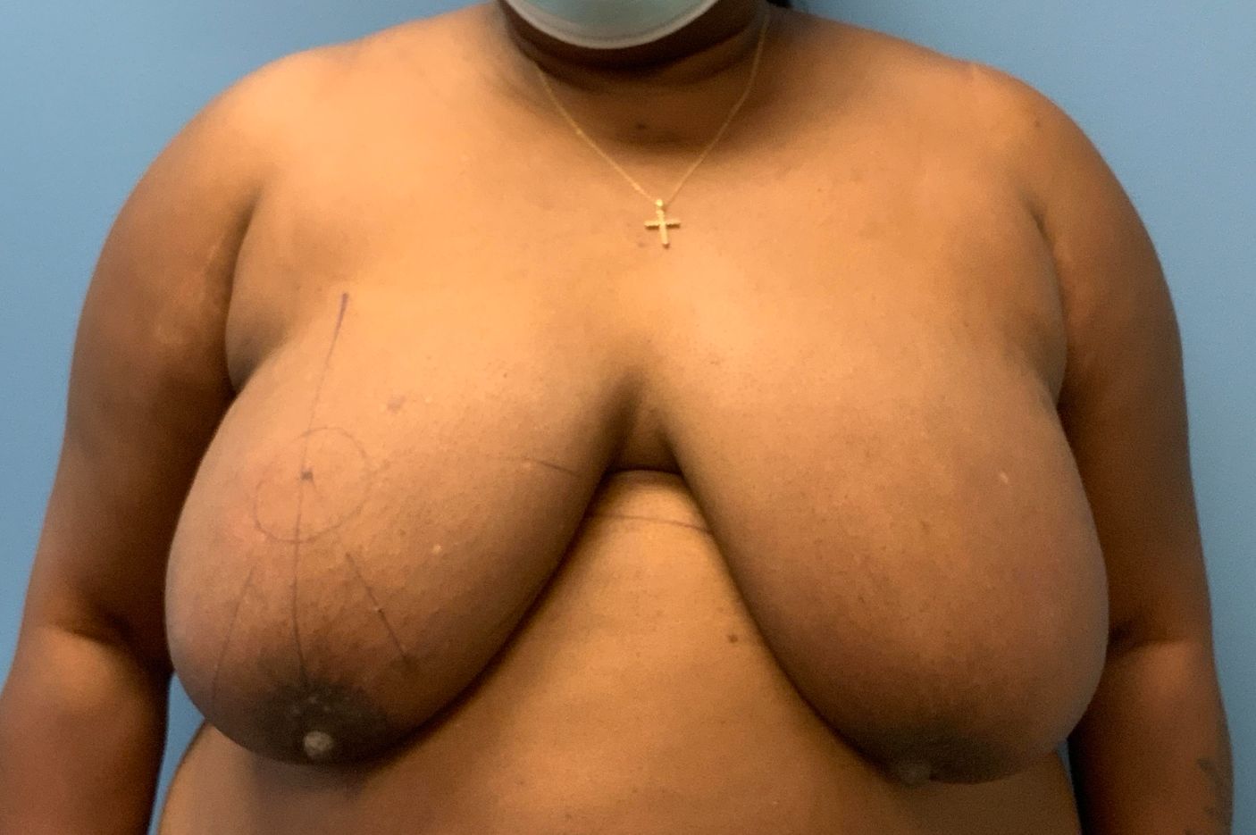 Before breast reduction front view female patient case 3996