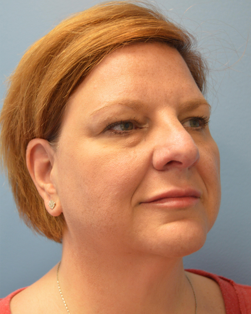 before brow lift diagonal view female patient case 3474