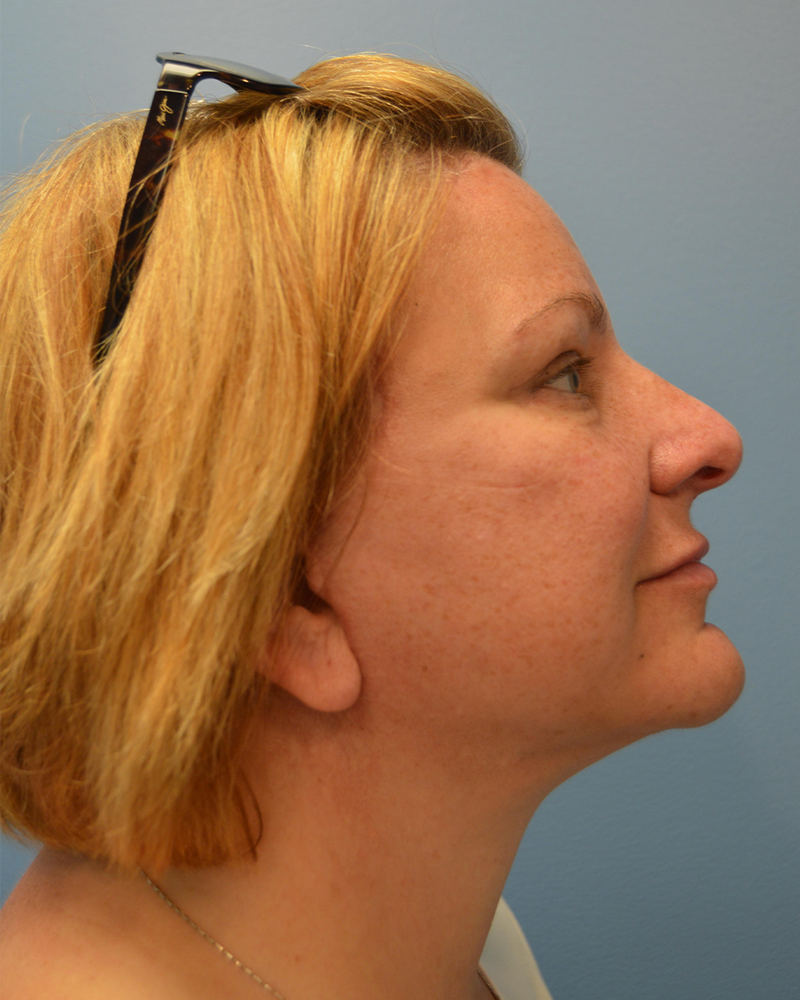 after brow lift side view female patient case 3474