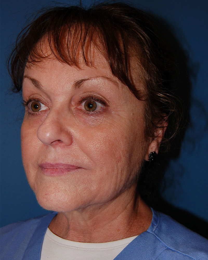 before Facelift left angle view female patient case 3192
