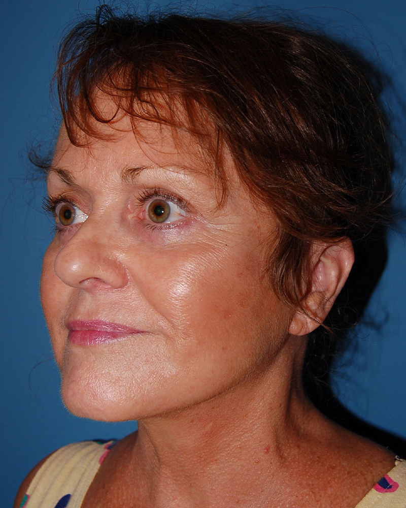after Facelift left angle view female patient case 3192