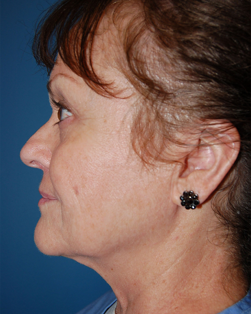 before Facelift left side view female patient case 3192