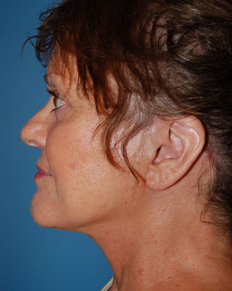 after Facelift left side view female patient case 3192