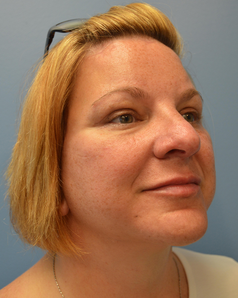 after facelift diagonal view female patient case 3479