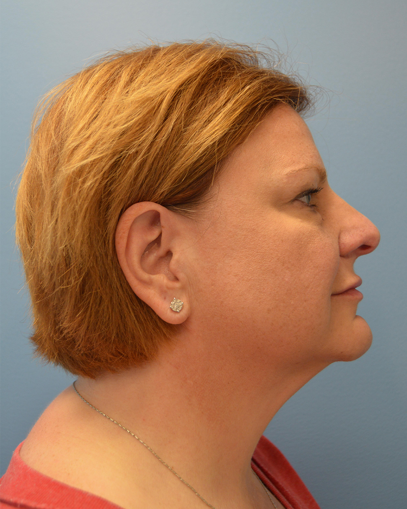 before facelift side view female patient case 3479
