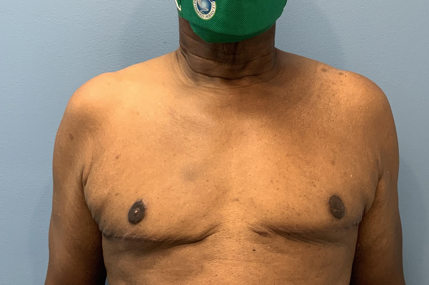 after gynecomastia male breast reduction front view Richmond, VA Zinsser Plastic Surgery