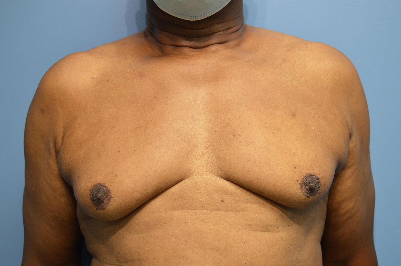 before gynecomastia male breast reduction front view Richmond, VA Zinsser Plastic Surgery