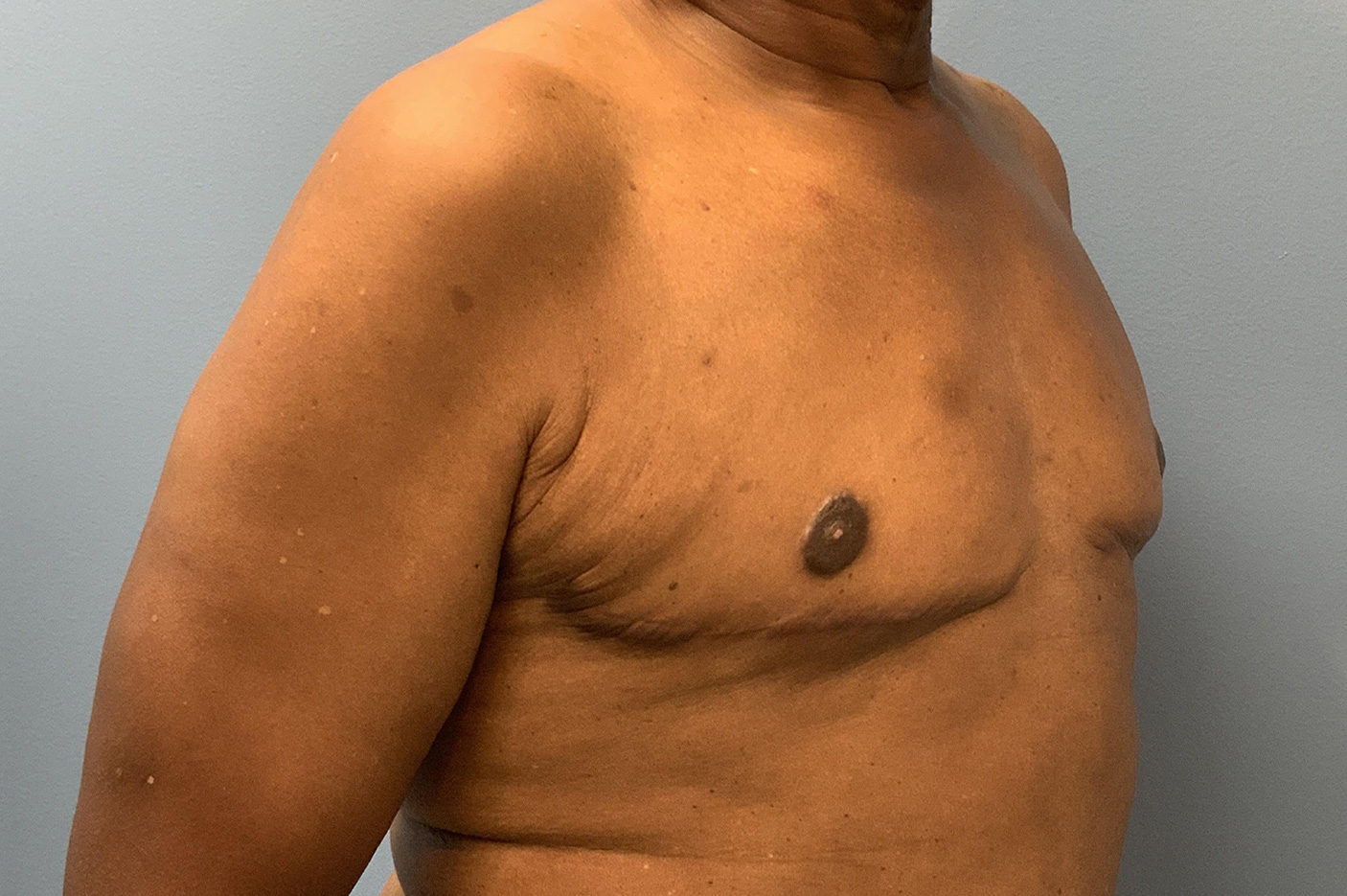 after gynecomastia male breast reduction diagonal view Richmond, VA Zinsser Plastic Surgery