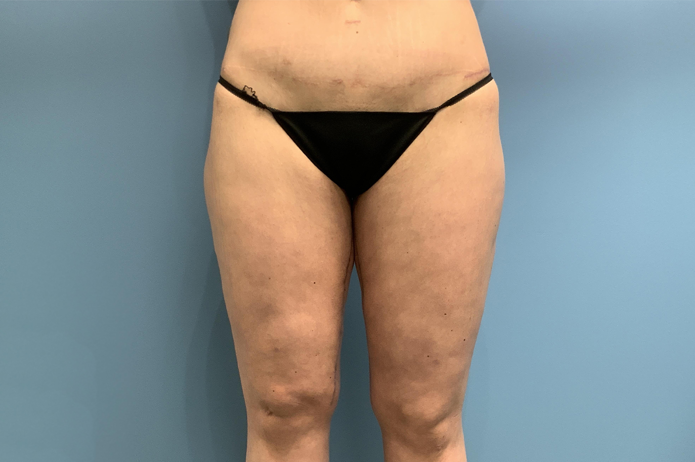 after liposuction front view female patient case 3762