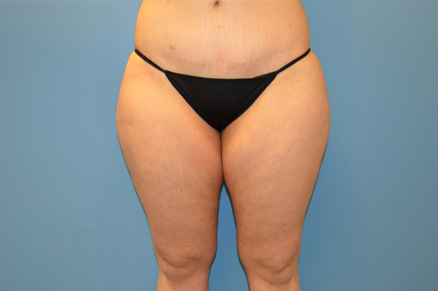 before liposuction front view female patient case 3762
