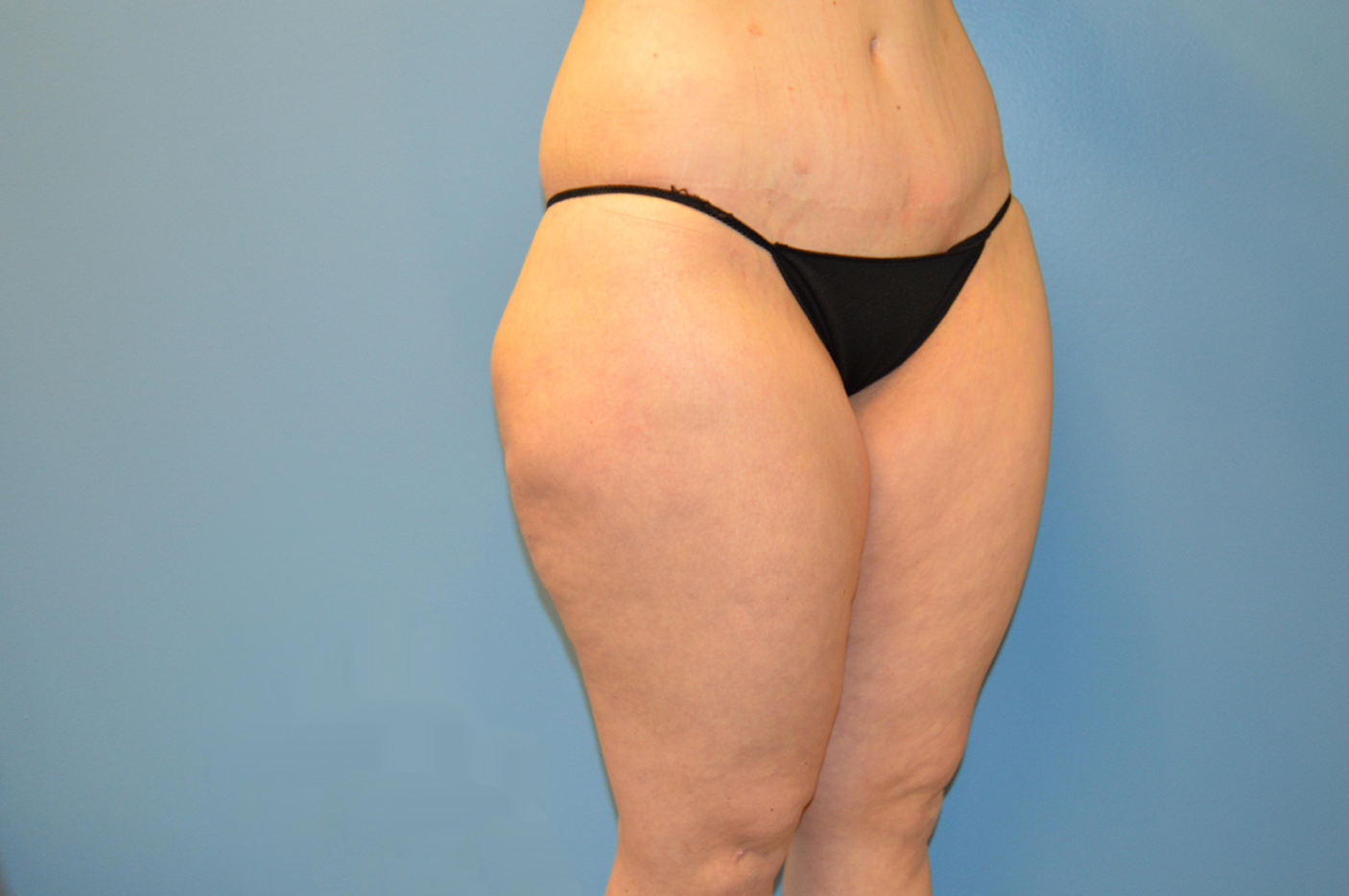 before liposuction diagonal view female patient case 3762