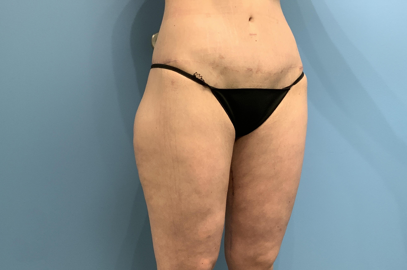 after liposuction diagonal view female patient case 3762
