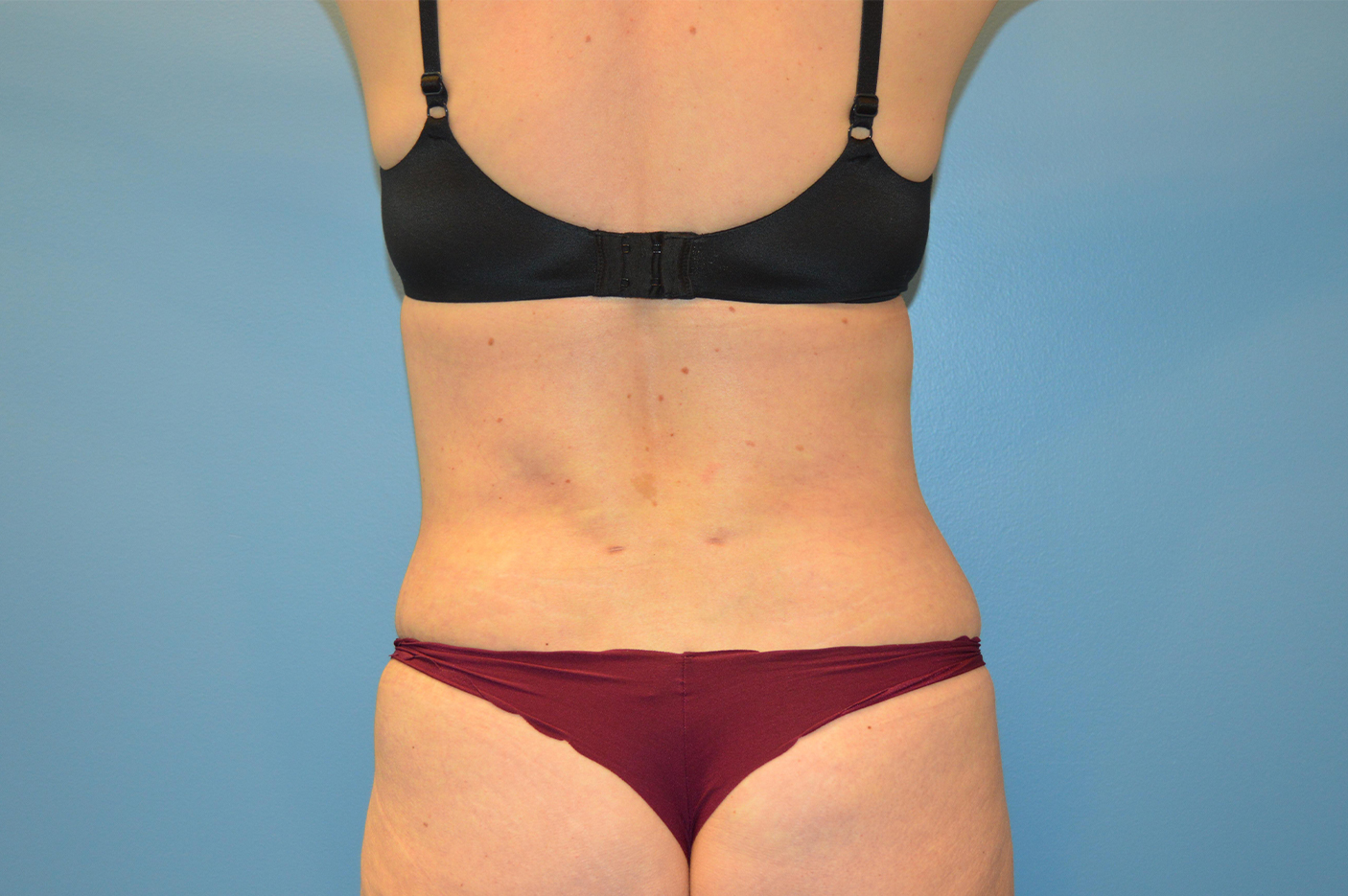 after liposuction back view female patient case 3772