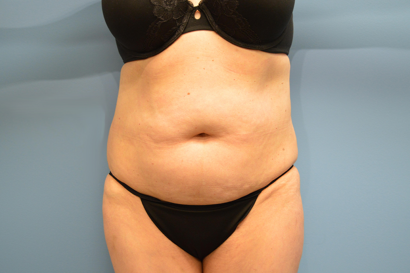 before liposuction front view female patient case 3772