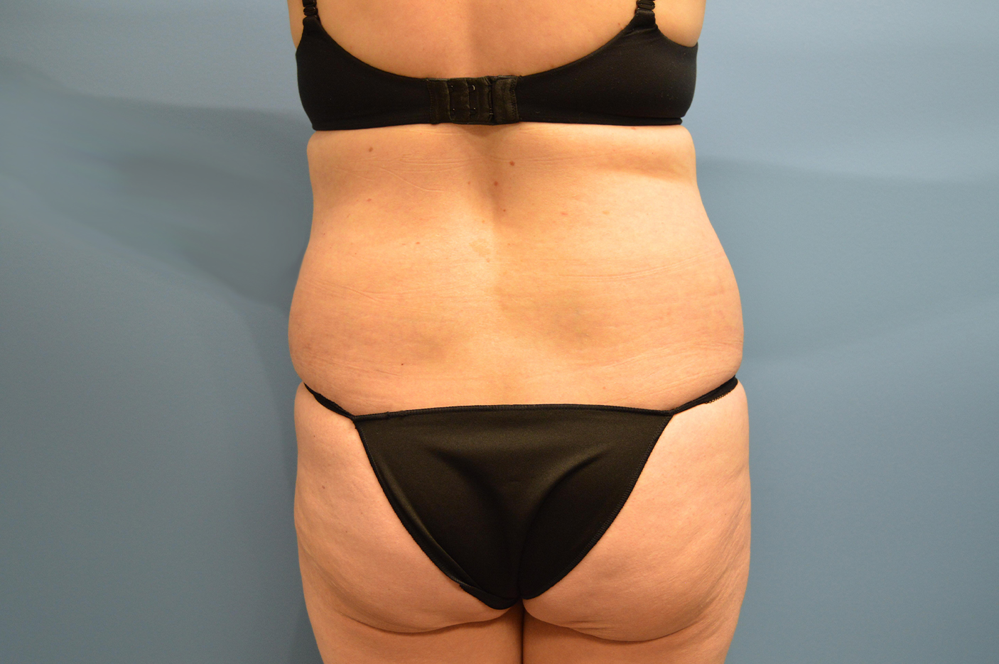 before liposuction back view female patient case 3772