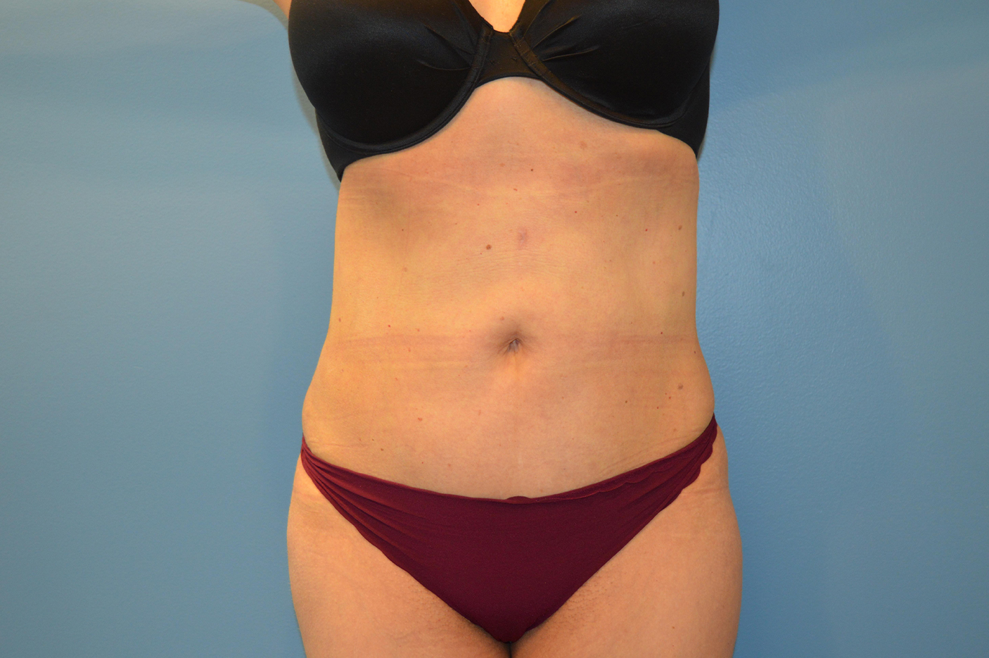 after liposuction front view female patient case 3772
