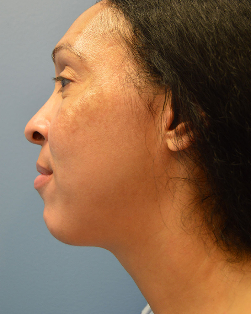 after Neck Lift left side view female patient case 3202