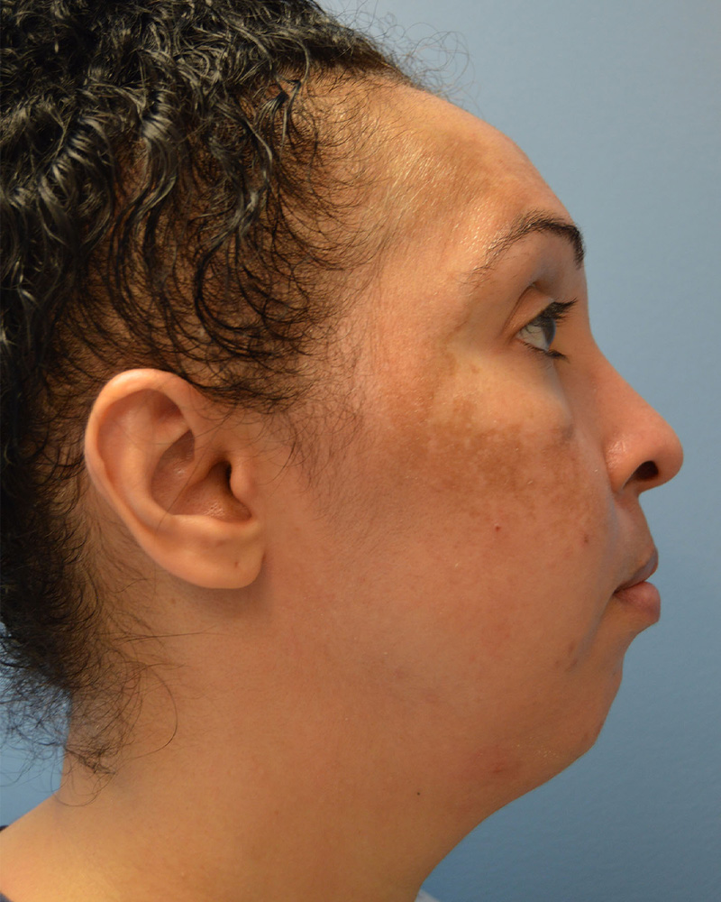 before Neck Lift right side view female patient case 3202