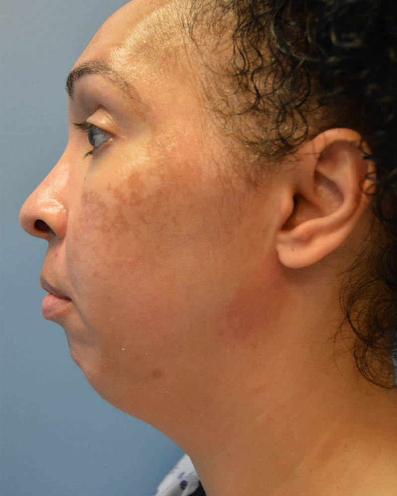 before Neck Lift left side view female patient case 3202