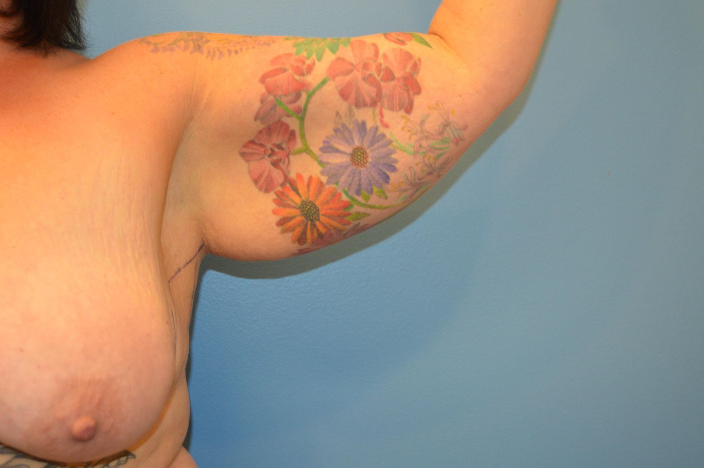 Before surgery after weightloss left arm view female patient case 4006