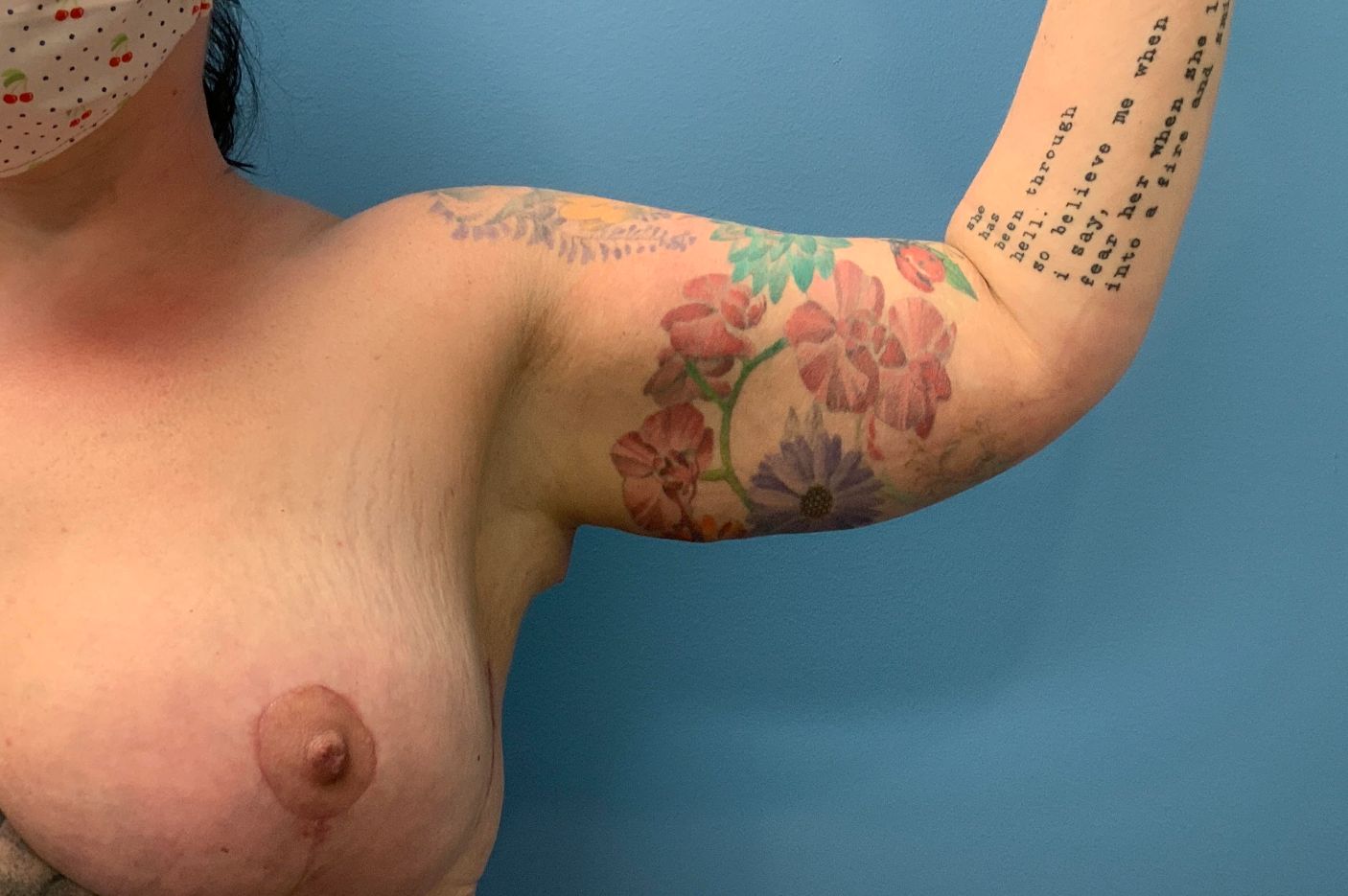 after surgery after weightloss left arm view female patient case 4006