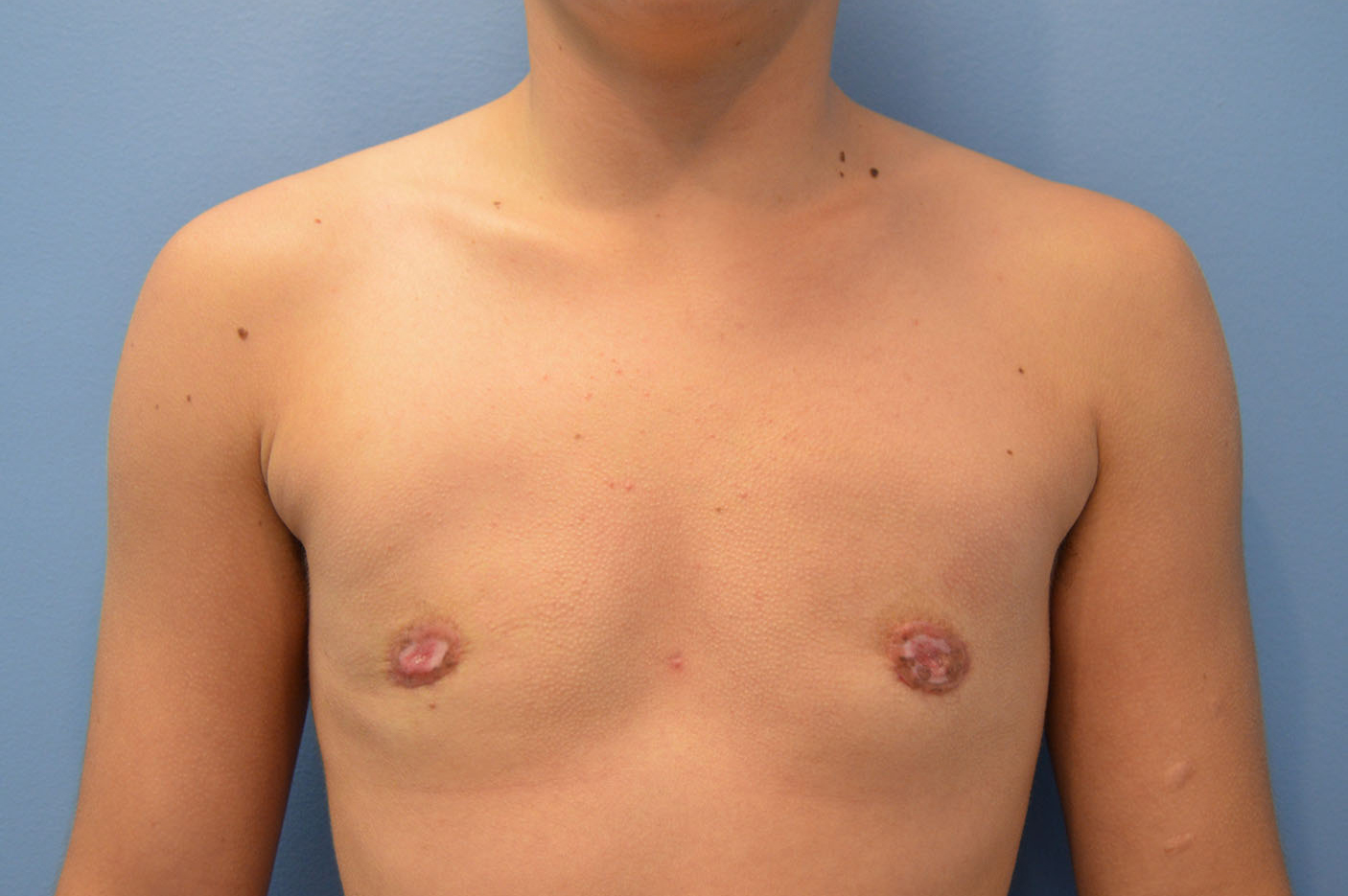 after transgender top surgery front view Richmond, VA Zinsser Plastic Surgery
