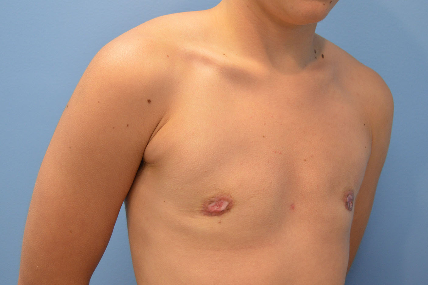 after transgender top surgery right angle view Richmond, VA Zinsser Plastic Surgery
