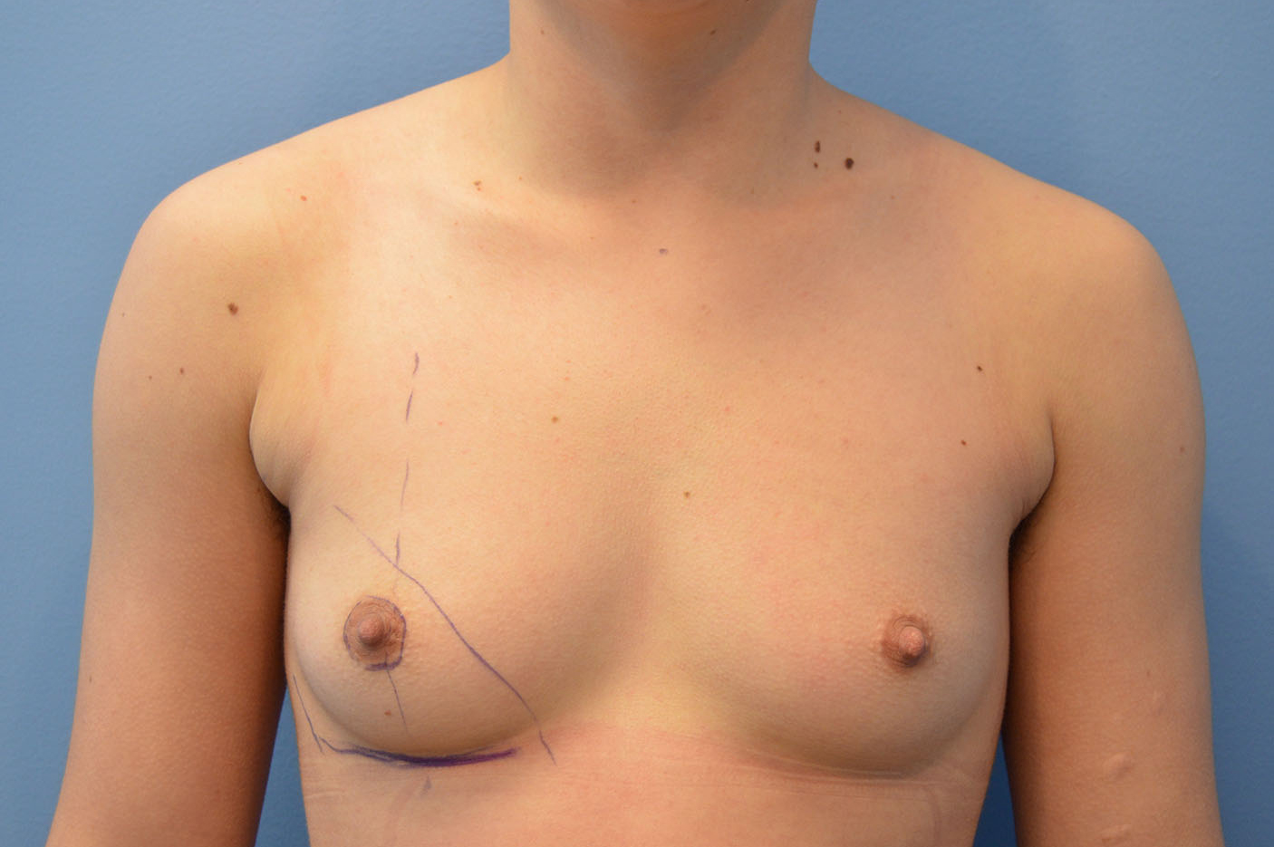 before transgender top surgery front view Richmond, VA Zinsser Plastic Surgery
