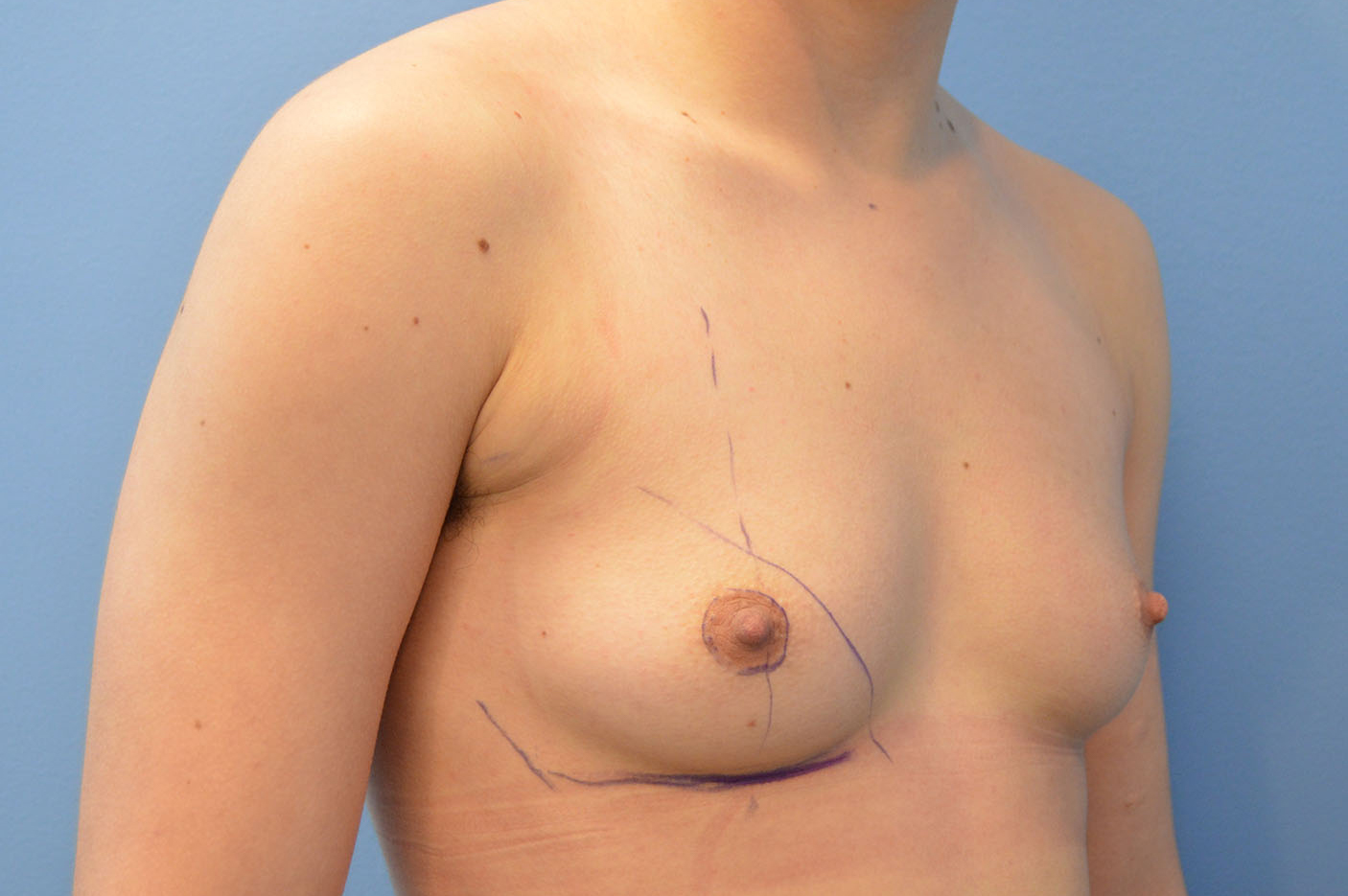 before transgender top surgery right angle view Richmond, VA Zinsser Plastic Surgery