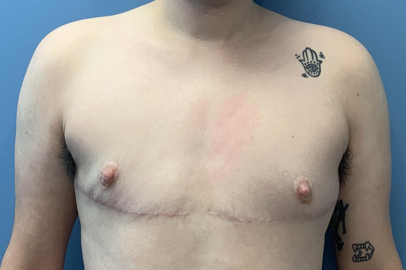 after transgender top surgery front view Richmond, VA Zinsser Plastic Surgery
