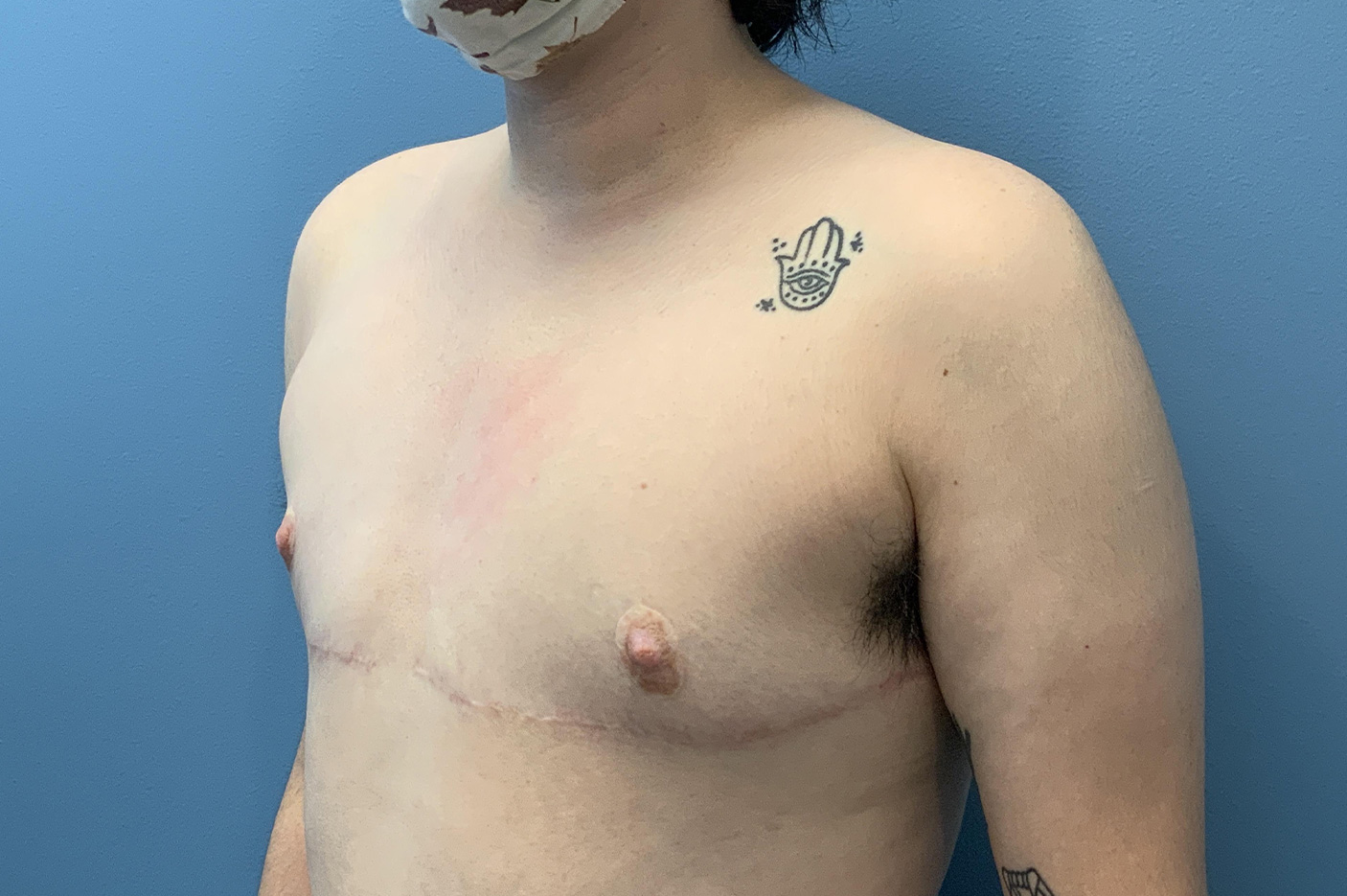after gynecomastia male breast reduction left angle view Richmond, VA Zinsser Plastic Surgery