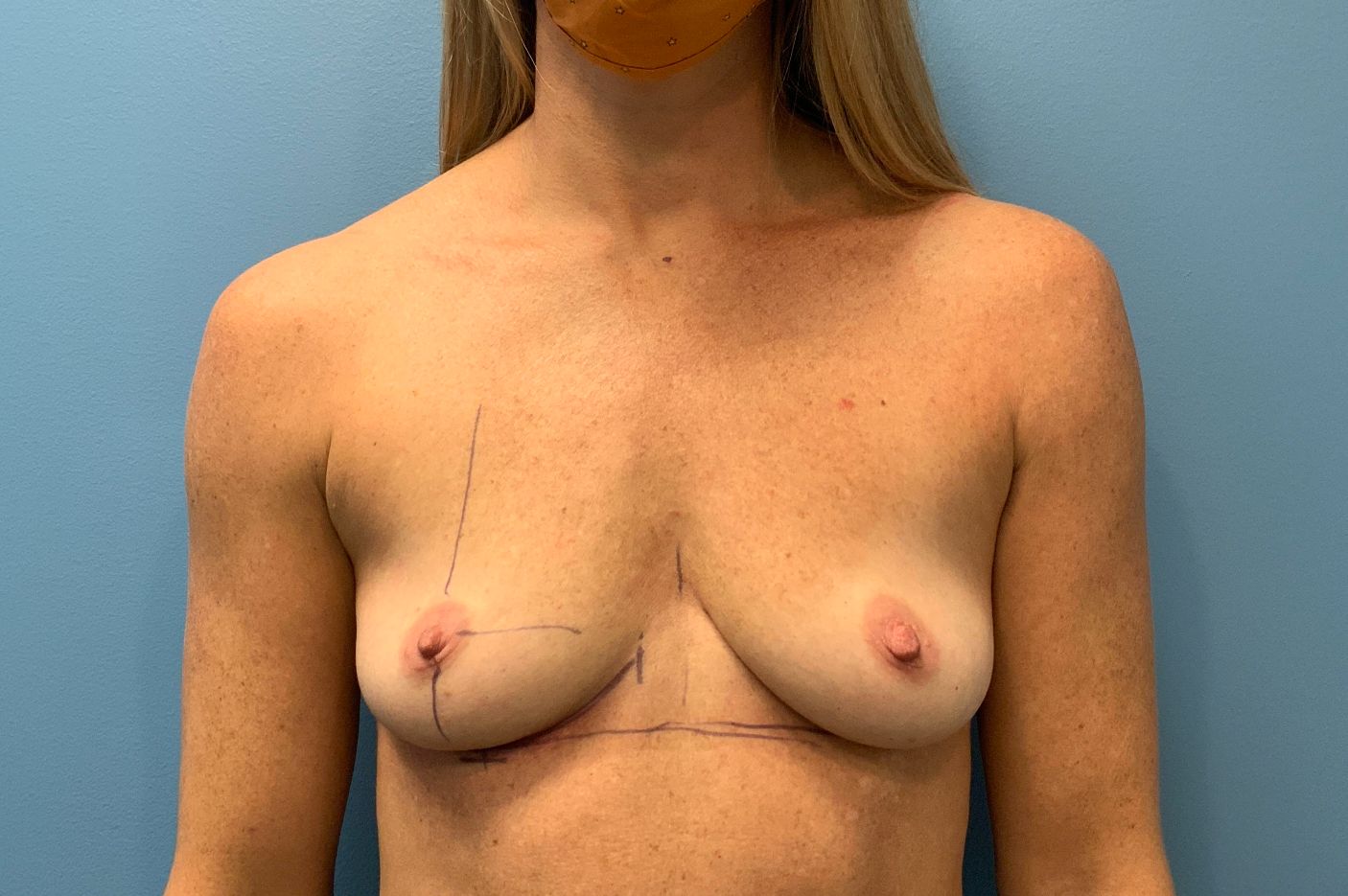 before breast augmentation front view female patient case 4297