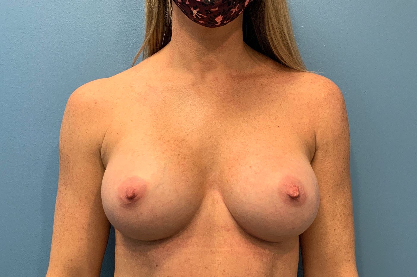 after breast augmentation front view female patient case 4297