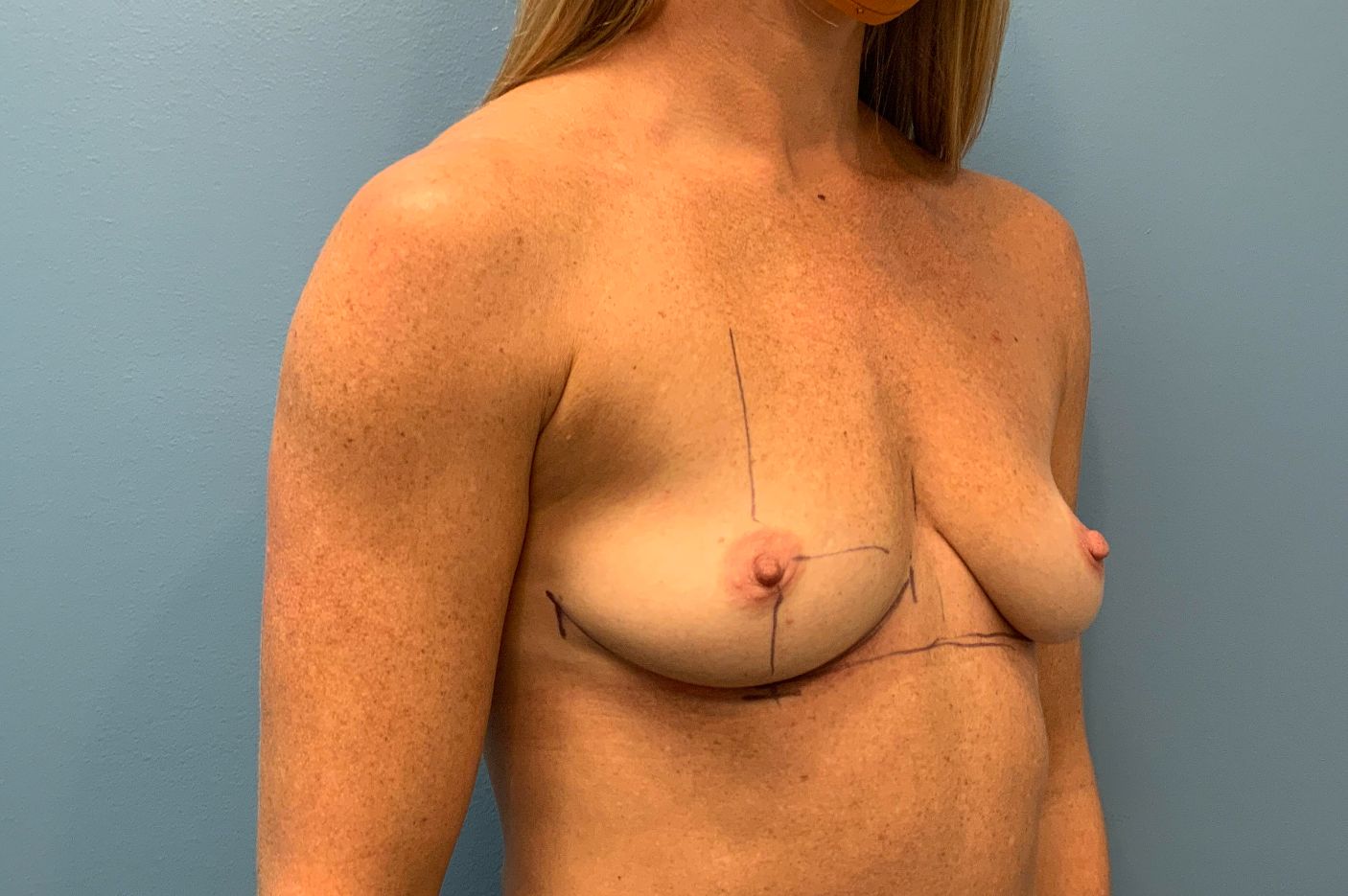 before breast augmentation right angle view female patient case 4297