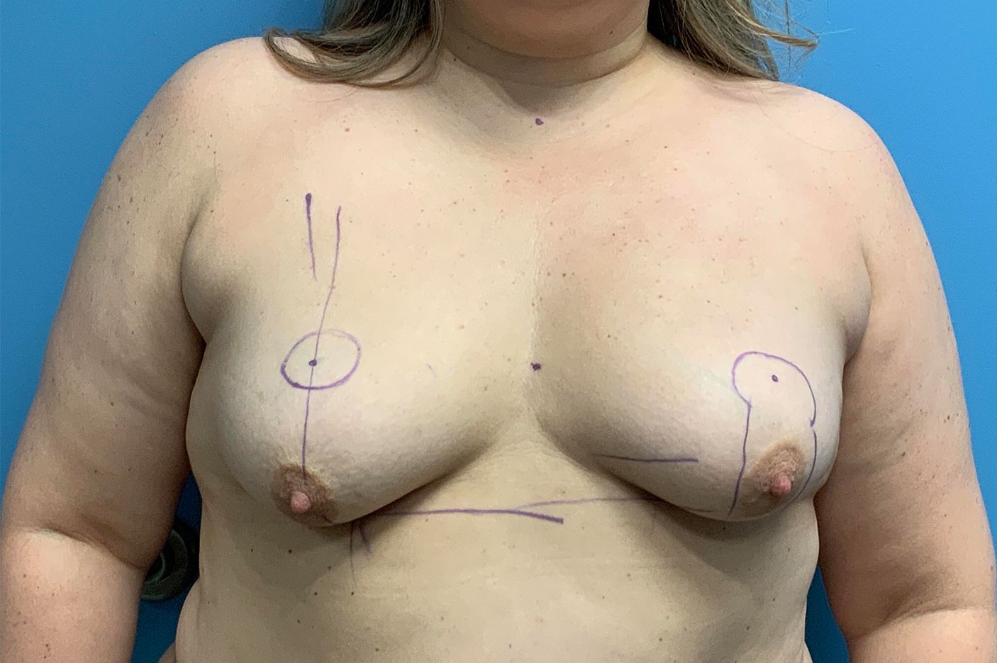 before breast augmentation + lift front view female patient case 4313