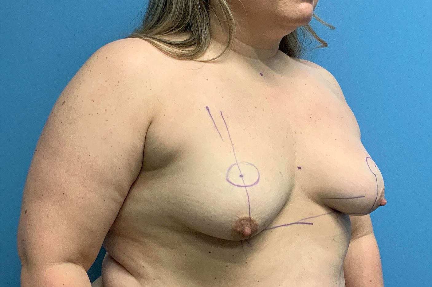 before breast augmentation + lift right angle view female patient case 4313