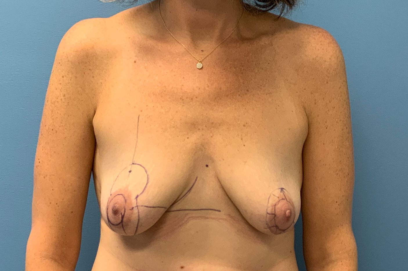 before breast augmentation + lift front view female patient case 4323