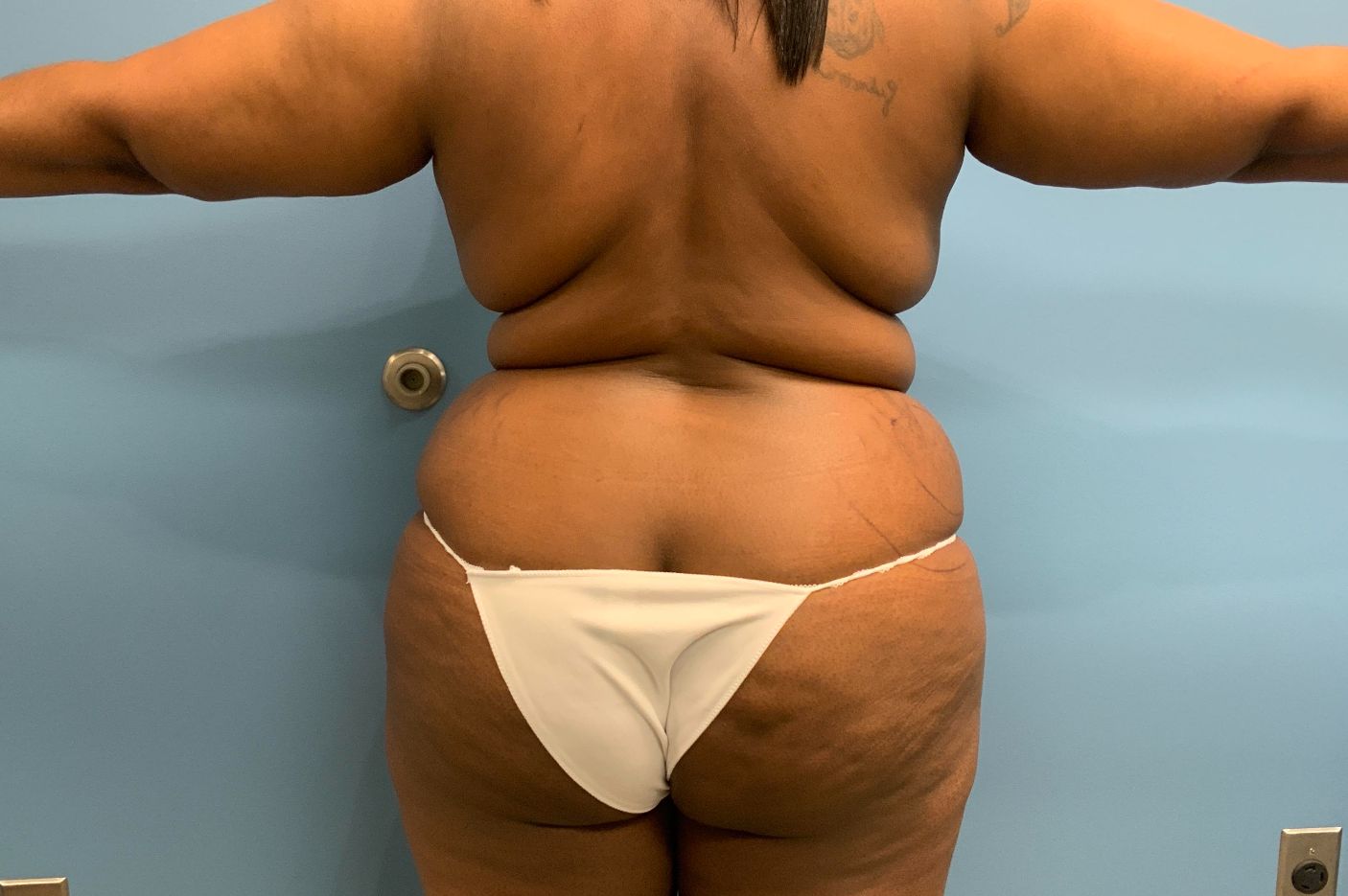 before liposuction back view female patient case 4250