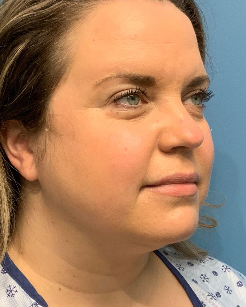 before neck lift right angle view of female patient case 4236