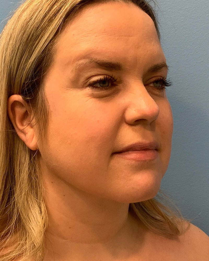 after neck lift right angle view of female patient case 4236